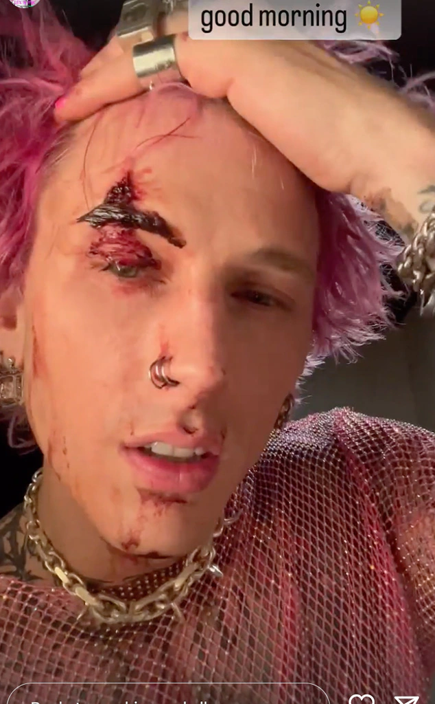 Machine Gun Kelly Gives Bizzare Excuse For Bloody Face “I Didn’t Have A Fork”